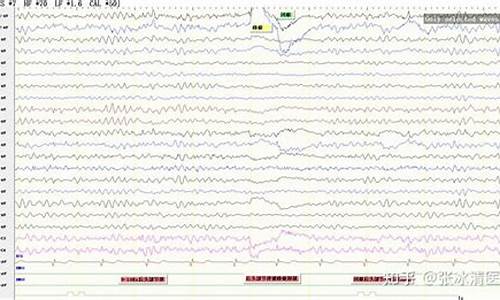 脑电图指标源码_脑电图报告单指标